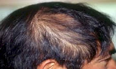 कोरोना से निजात पाने के बाद भी रहें सावधान, इस गंभीर समस्या से पड़ सकता है जूझना